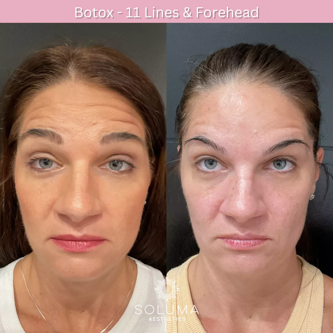 Botox before and after 1