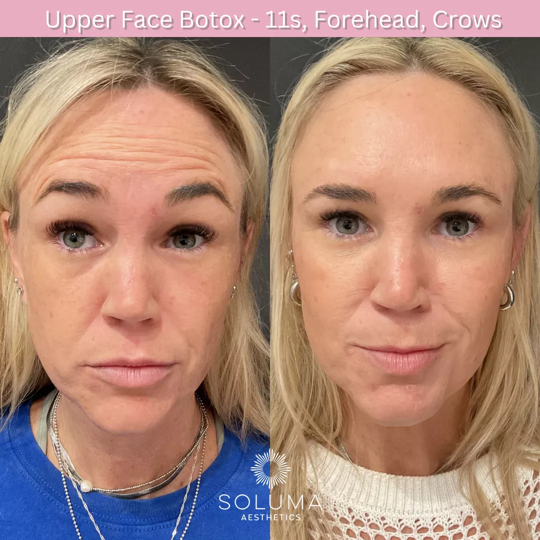 Botox before and after 10