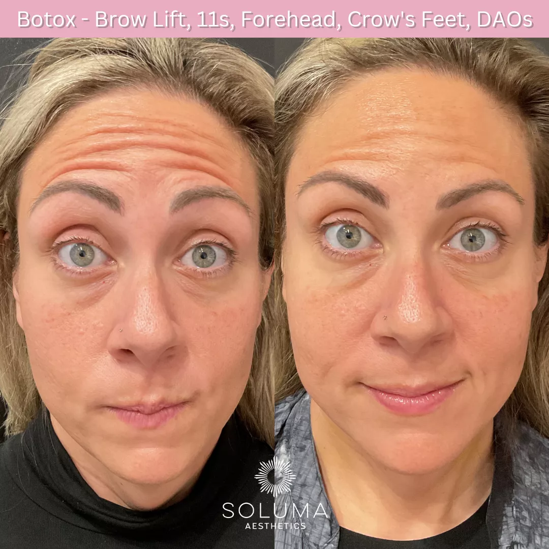 Botox before and after 11
