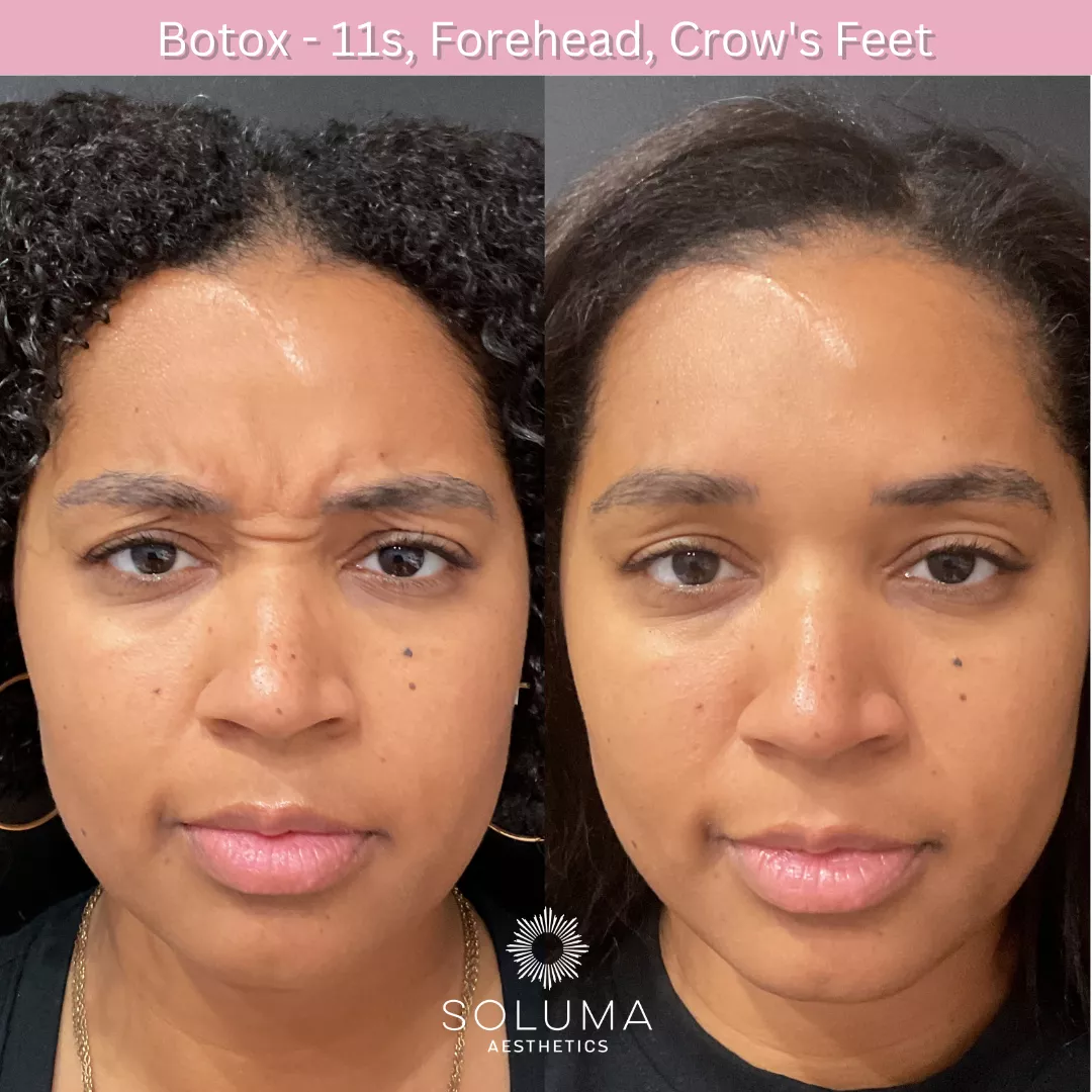Botox before and after 12