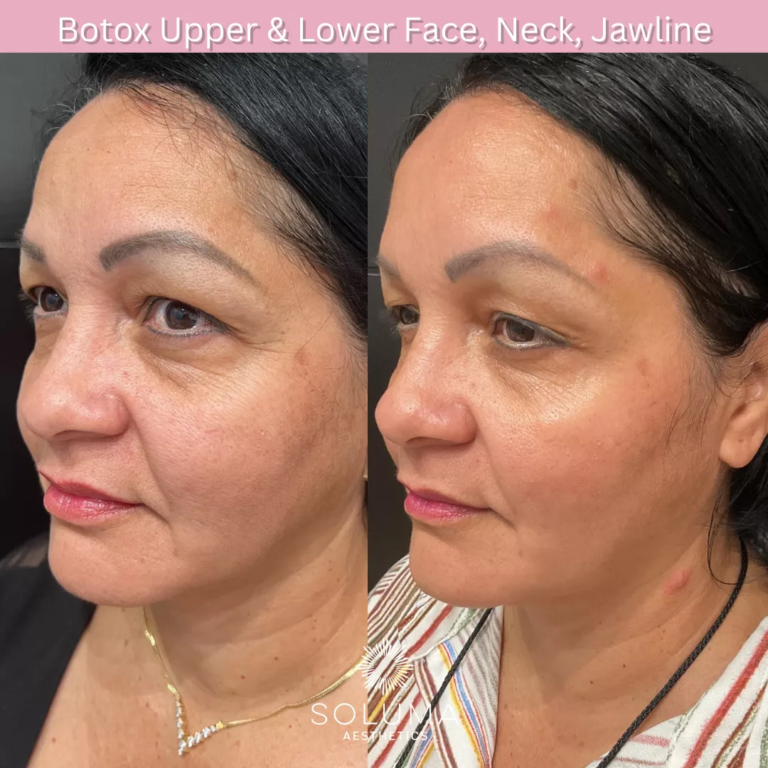 Botox before and after 13