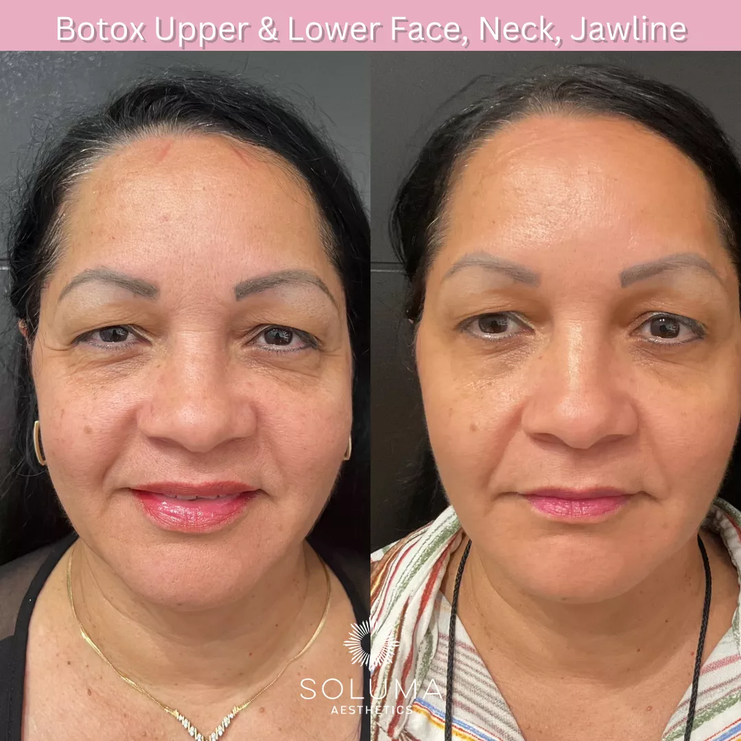 Botox before and after 14