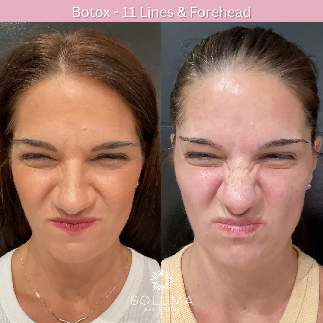 Botox before and after 15