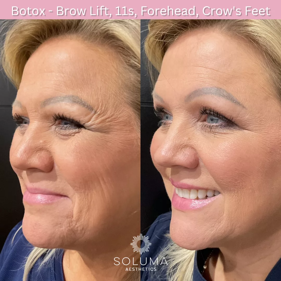 Botox before and after 2