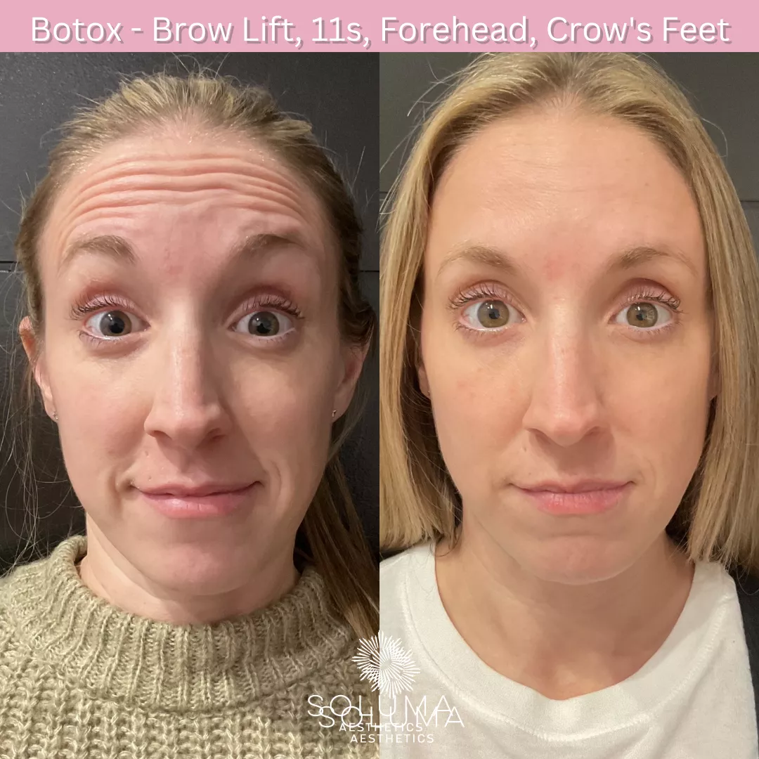 Botox before and after 3