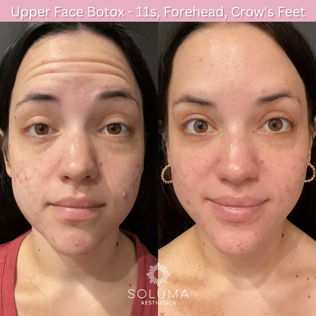 Botox before and after 4