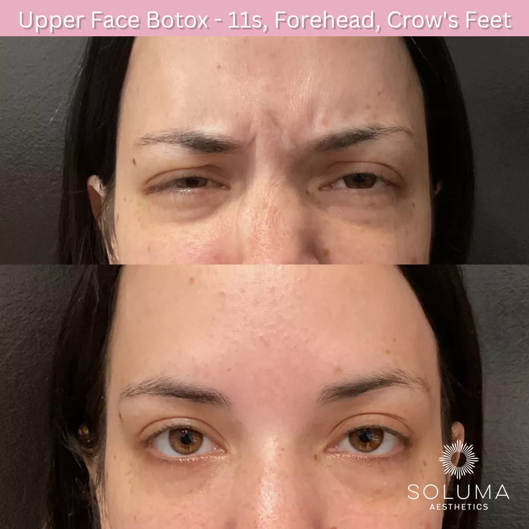 Botox before and after 5