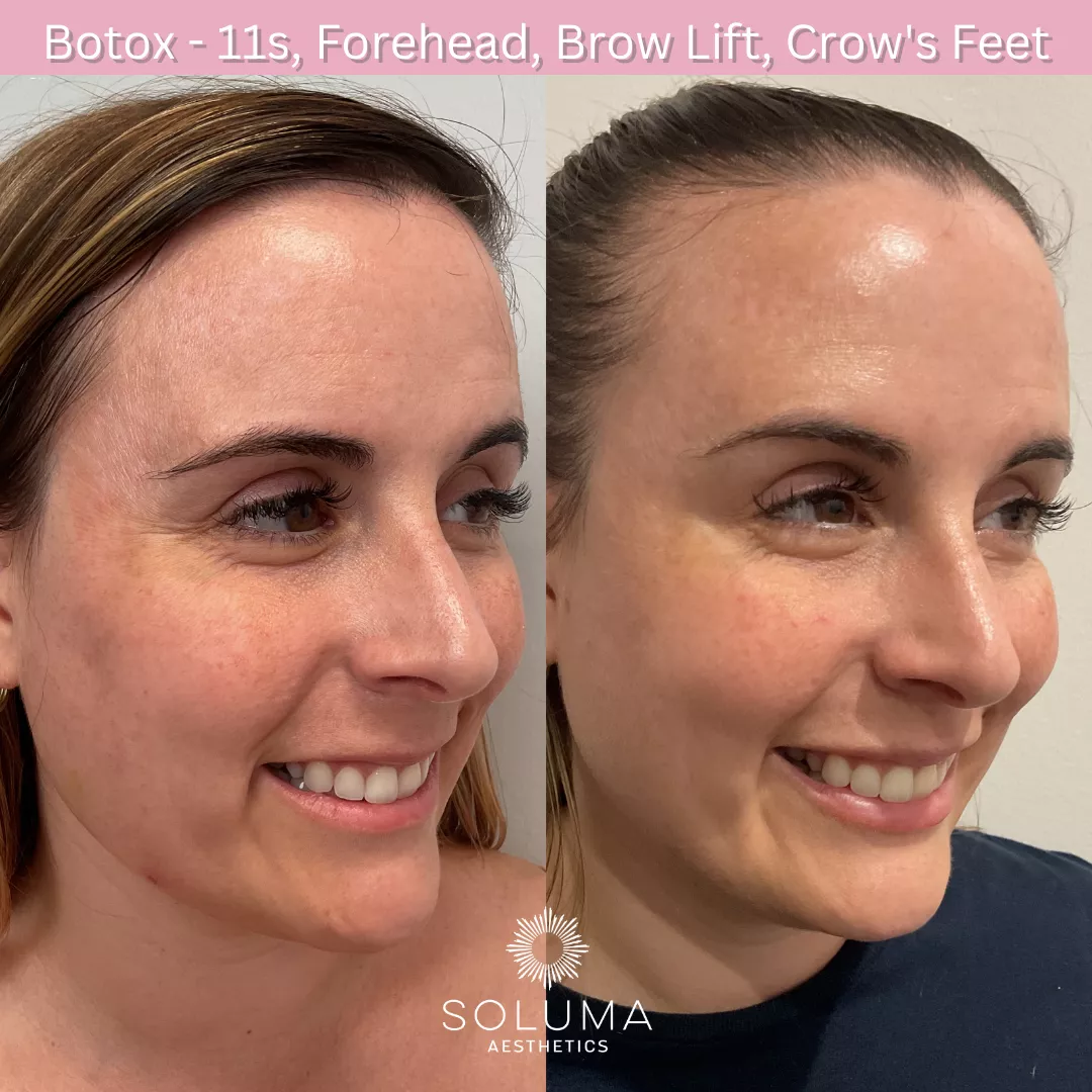 Botox before and after 6