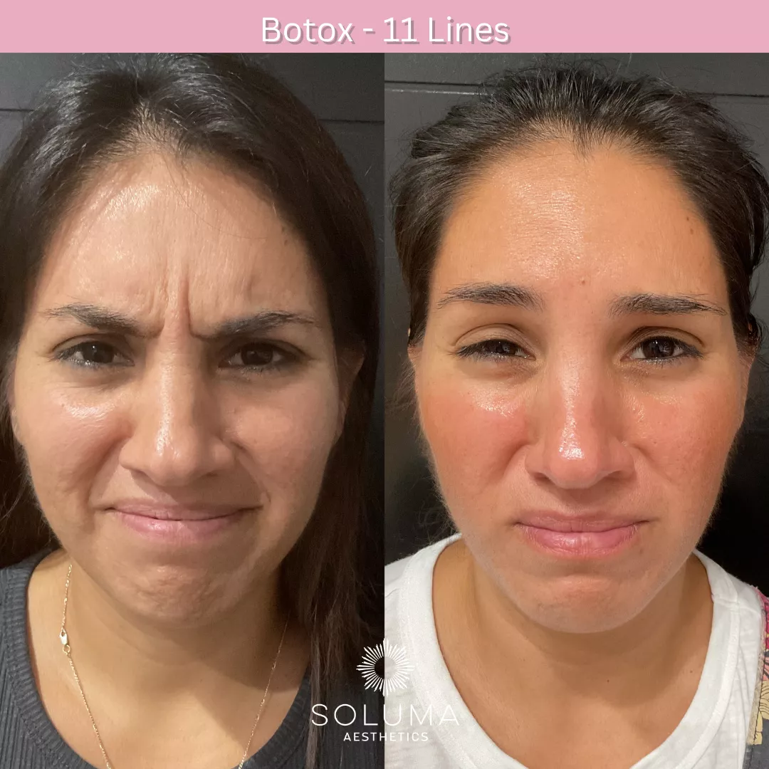 Botox before and after 7