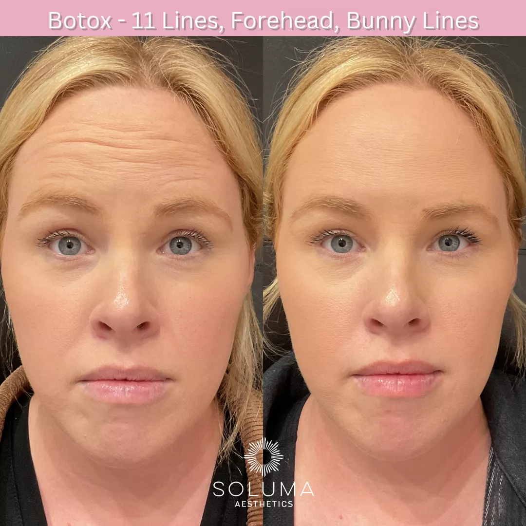 Botox before and after 8