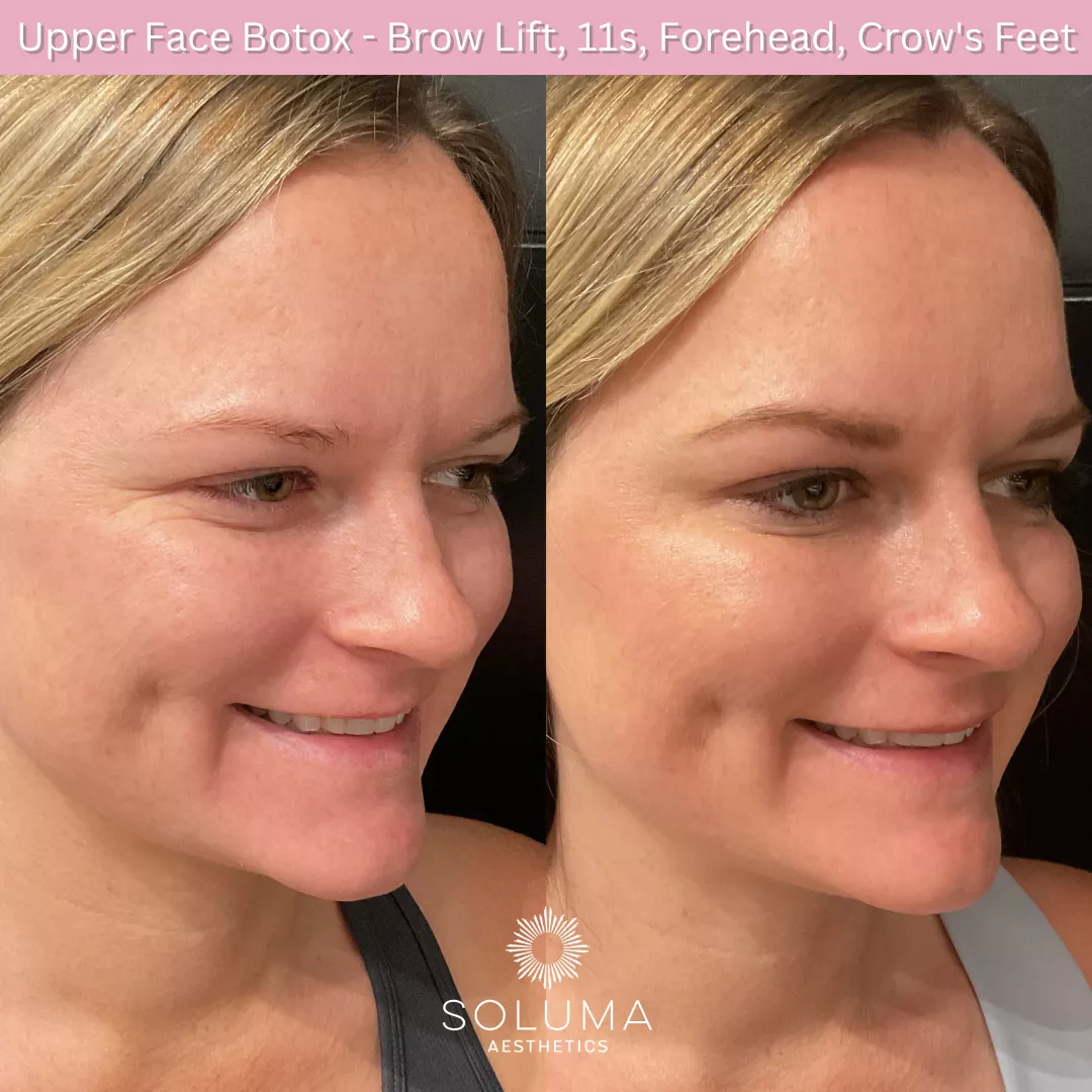 Botox before and after 9