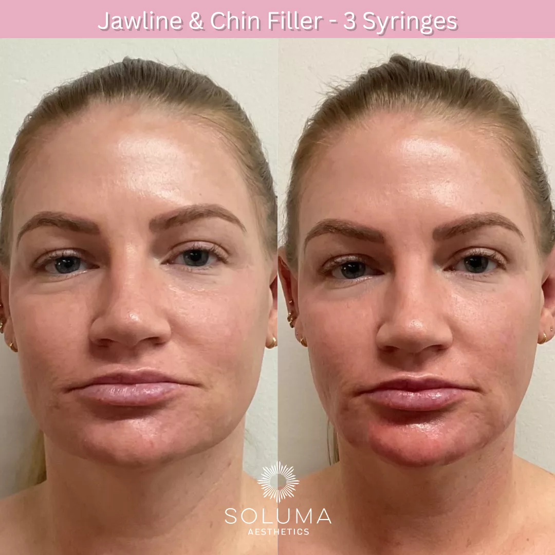 Dermal filler before and after 1