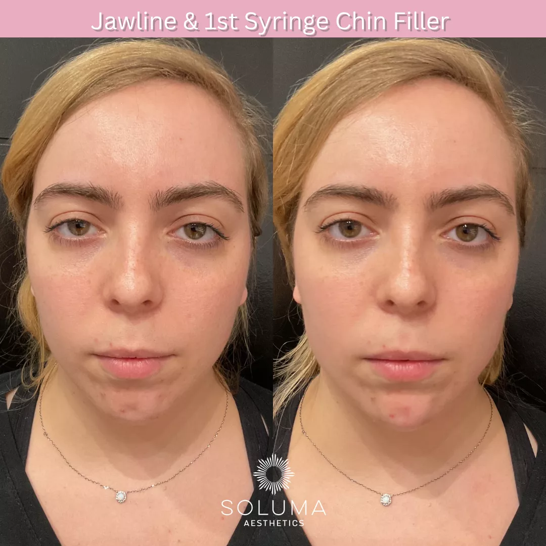 Dermal filler before and after 10
