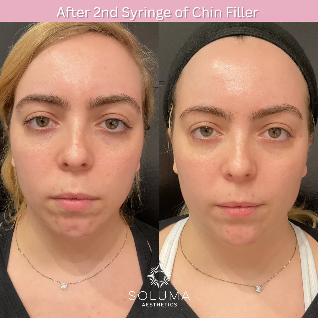 Dermal filler before and after 2