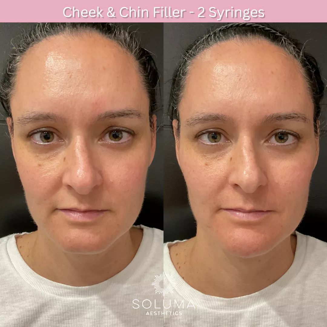 Dermal filler before and after 3