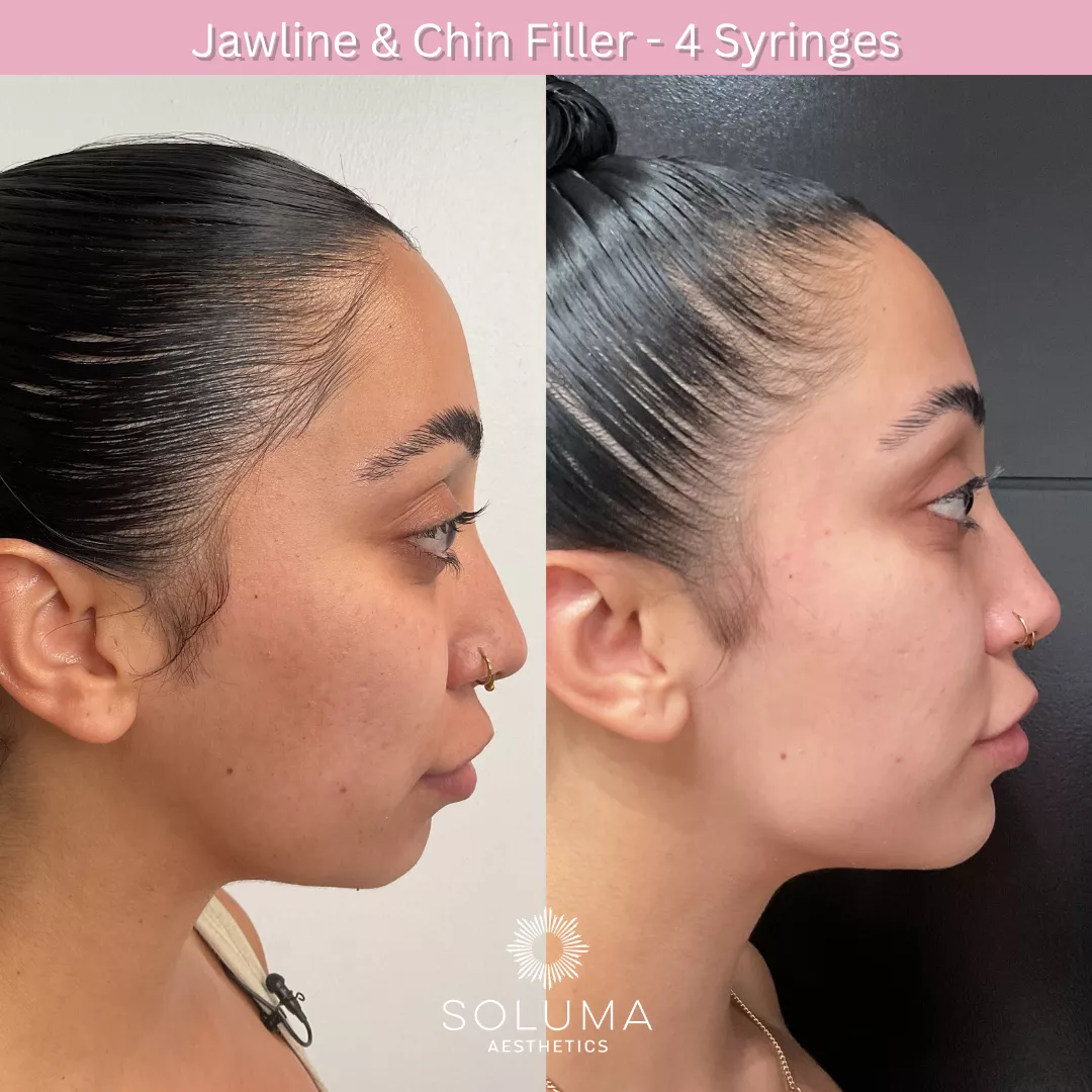 Dermal filler before and after 4