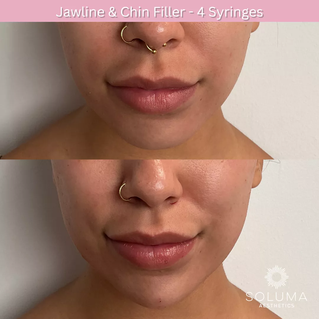 Dermal filler before and after 5