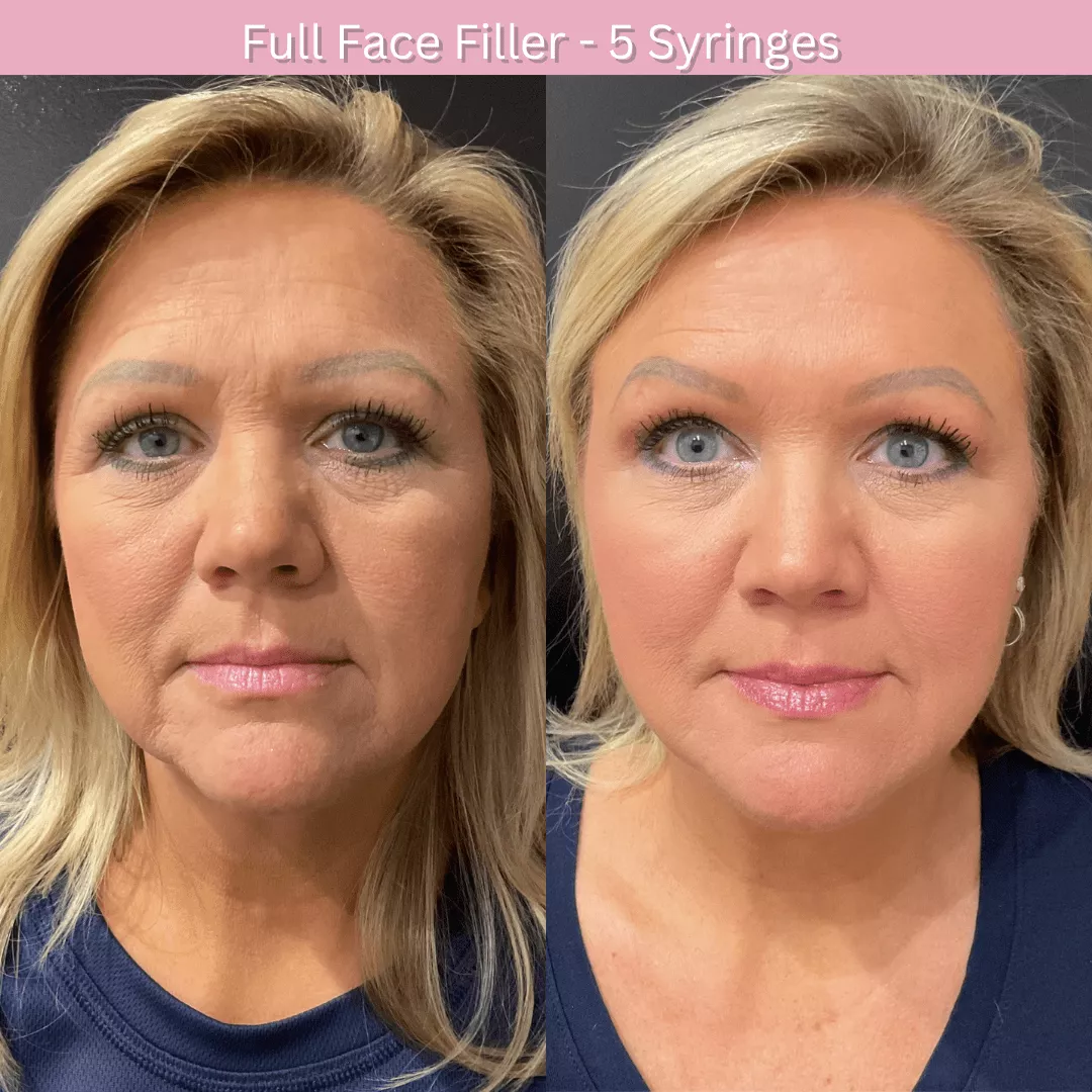 Dermal filler before and after 6