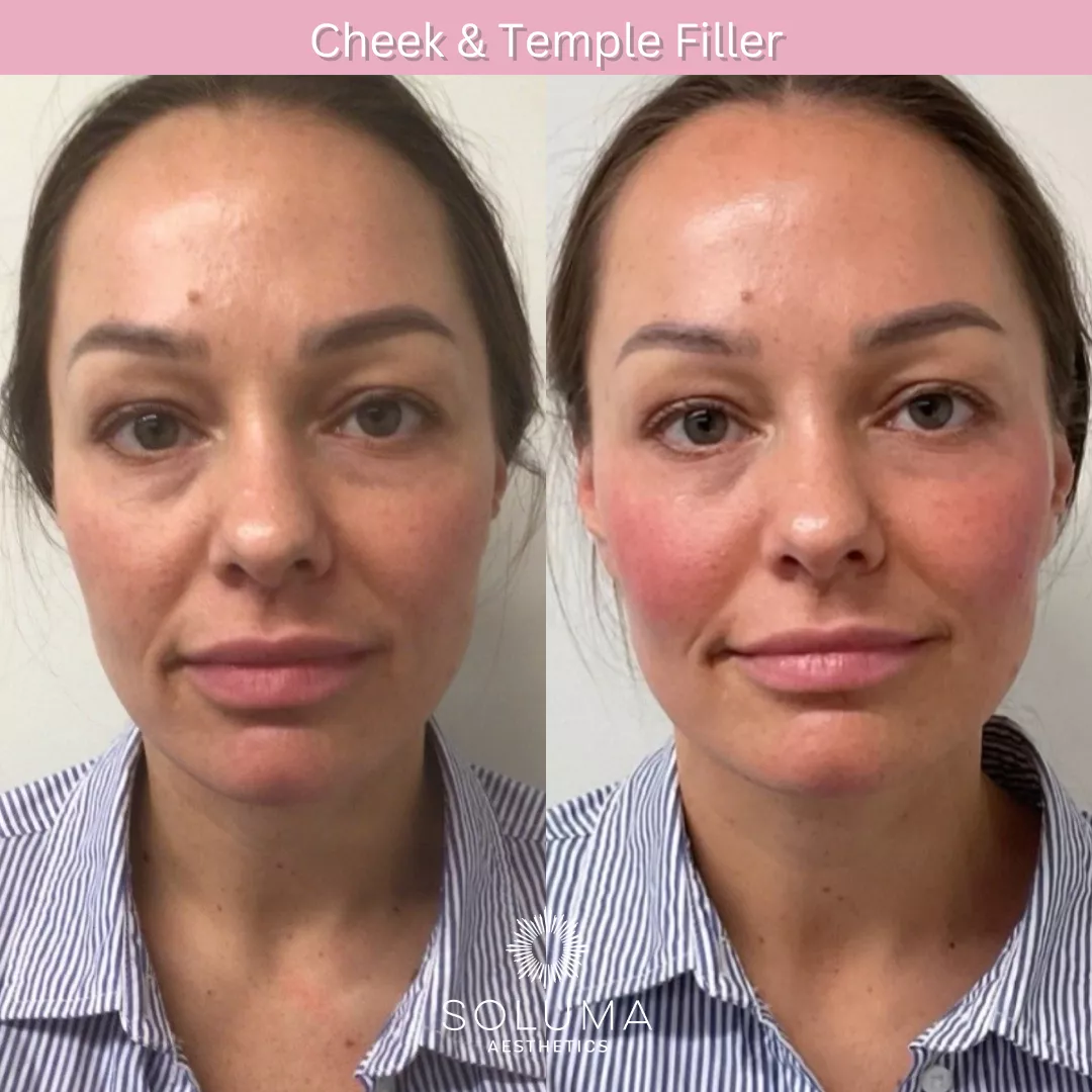 Dermal filler before and after 7