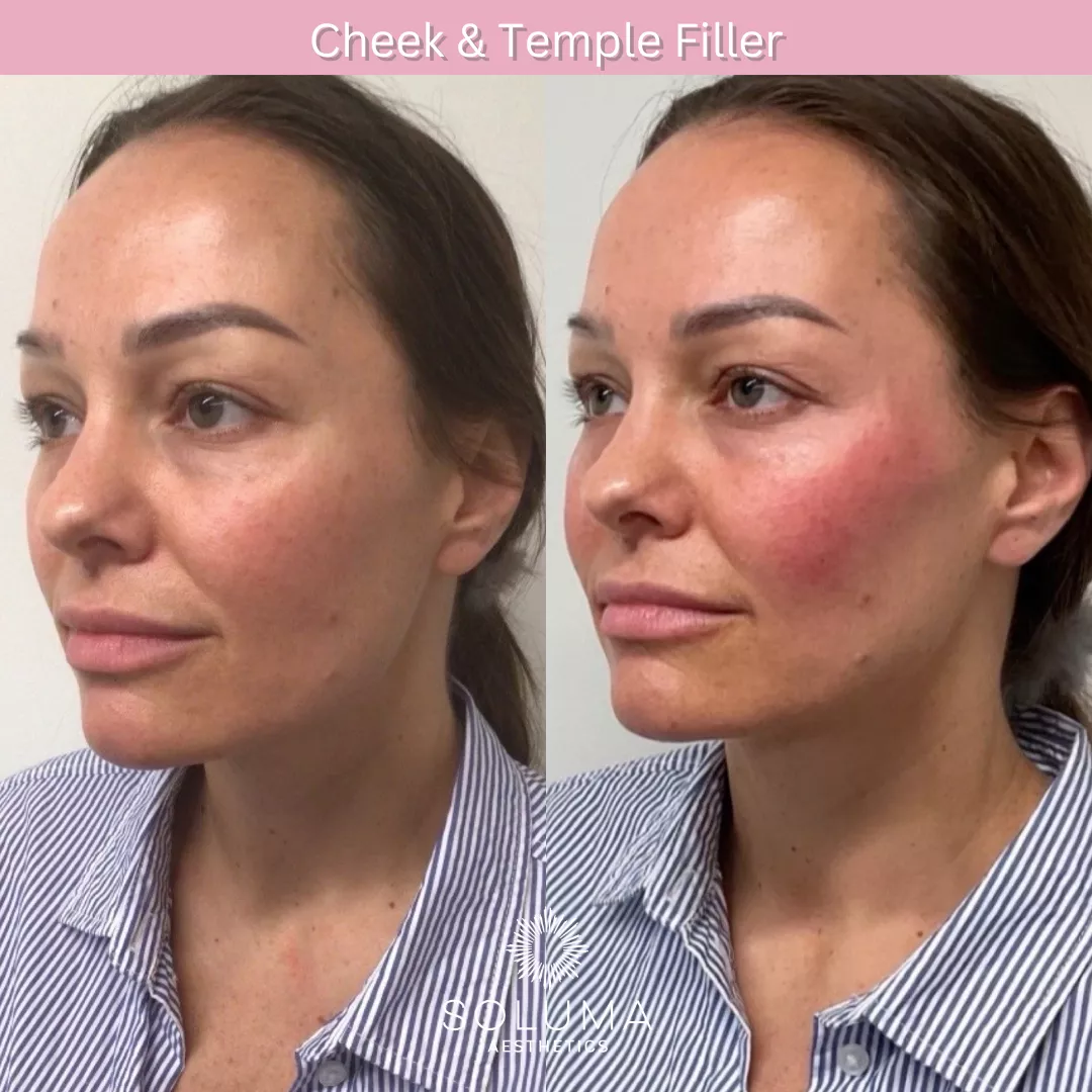 Dermal filler before and after 8