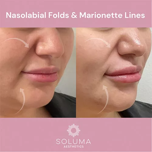 Dermal filler before and after 9